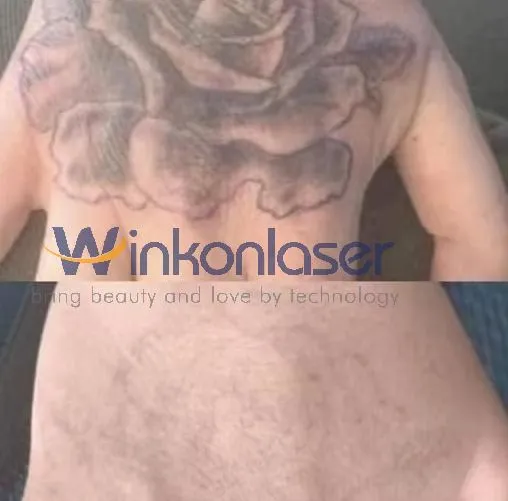 خدمة تصنيع المعدات الأصلية وتصنيع التصميمات الأصلية لإزالة البقع بالليزر بيكو ليزر لإزالة الوشم آلة ليزر ND YAG