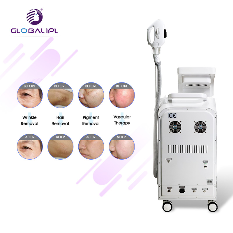 تقنية IPL+RF لإزالة الشعر وتجديد البشرة