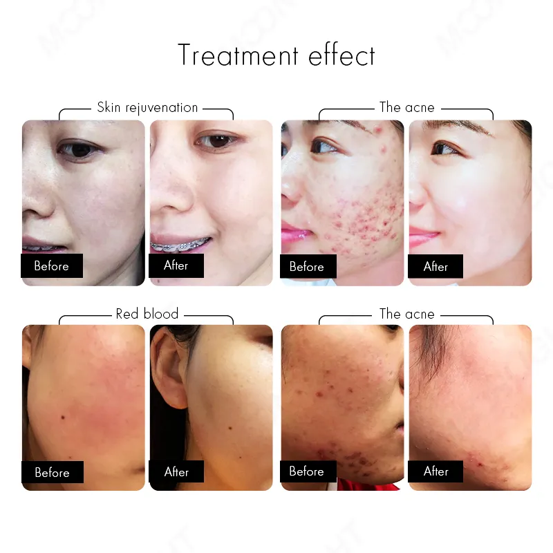 2in1 جهاز إزالة الشعر بالليزر الثنائي الجمالي IPL تجديد البشرة