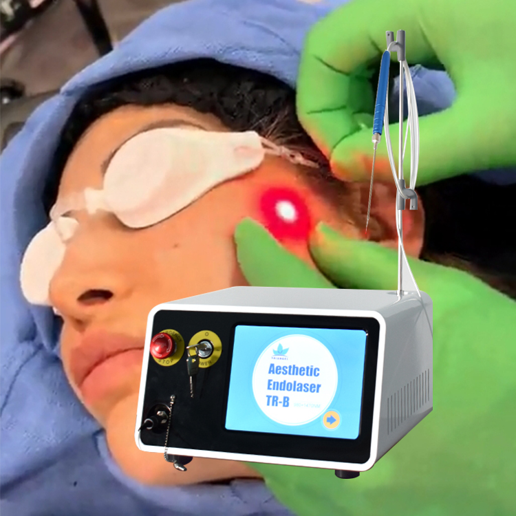إزالة الدهون بالليزر باستخدام جهاز الليزر الطبي 1470nm 980nm علاج إزالة الدهون بالليزر العلاج بالليزر الداخلي