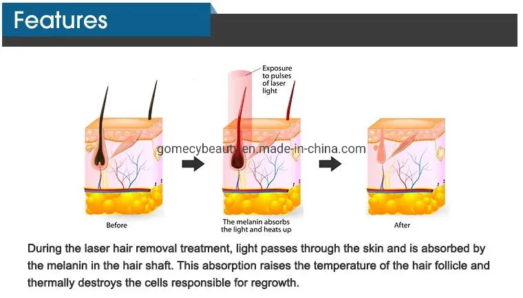 ليزر ديود IPL أو بيكوليزر IPL لتجديد البشرة وإزالة الشعر ومعدات جمال البشرة