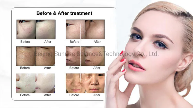 آلة ليزر إير ياج الاحترافية CO2 fractional 1550 لإزالة الندبات وتجديد البشرة باستخدام زجاج ياج 1550 لجمال صالون السبا