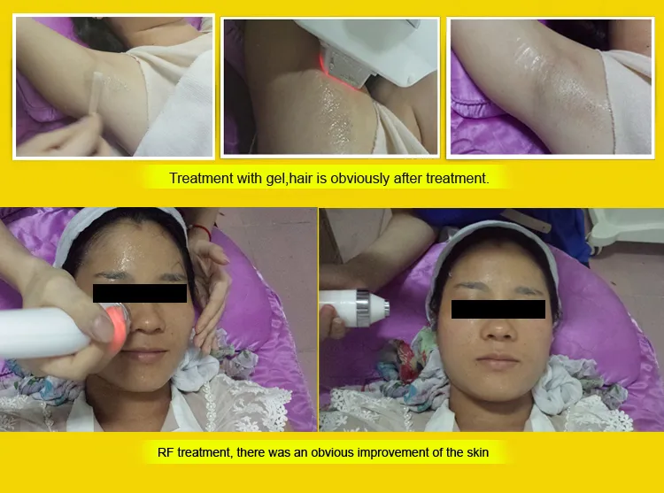 آلة إزالة الشعر بدون ألم بتقنية IPL أوبت بيوتي