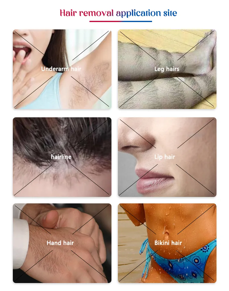 آلة إزالة الشعر بالليزر السريعة لعلاج حب الشباب وتجديد البشرة باستخدام تقنية الإضاءة المكثفة