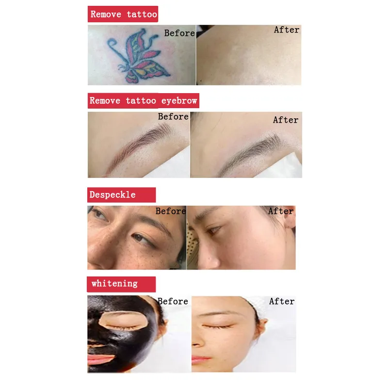 تأثيرات إزالة الشعر بالليزر