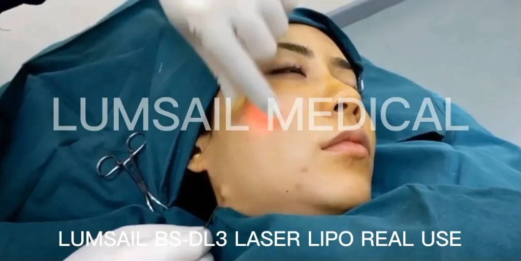 بديل إندوليفت 1470nm جهاز ليزر لشد الجلد وفقدان الدهون الصغيرة