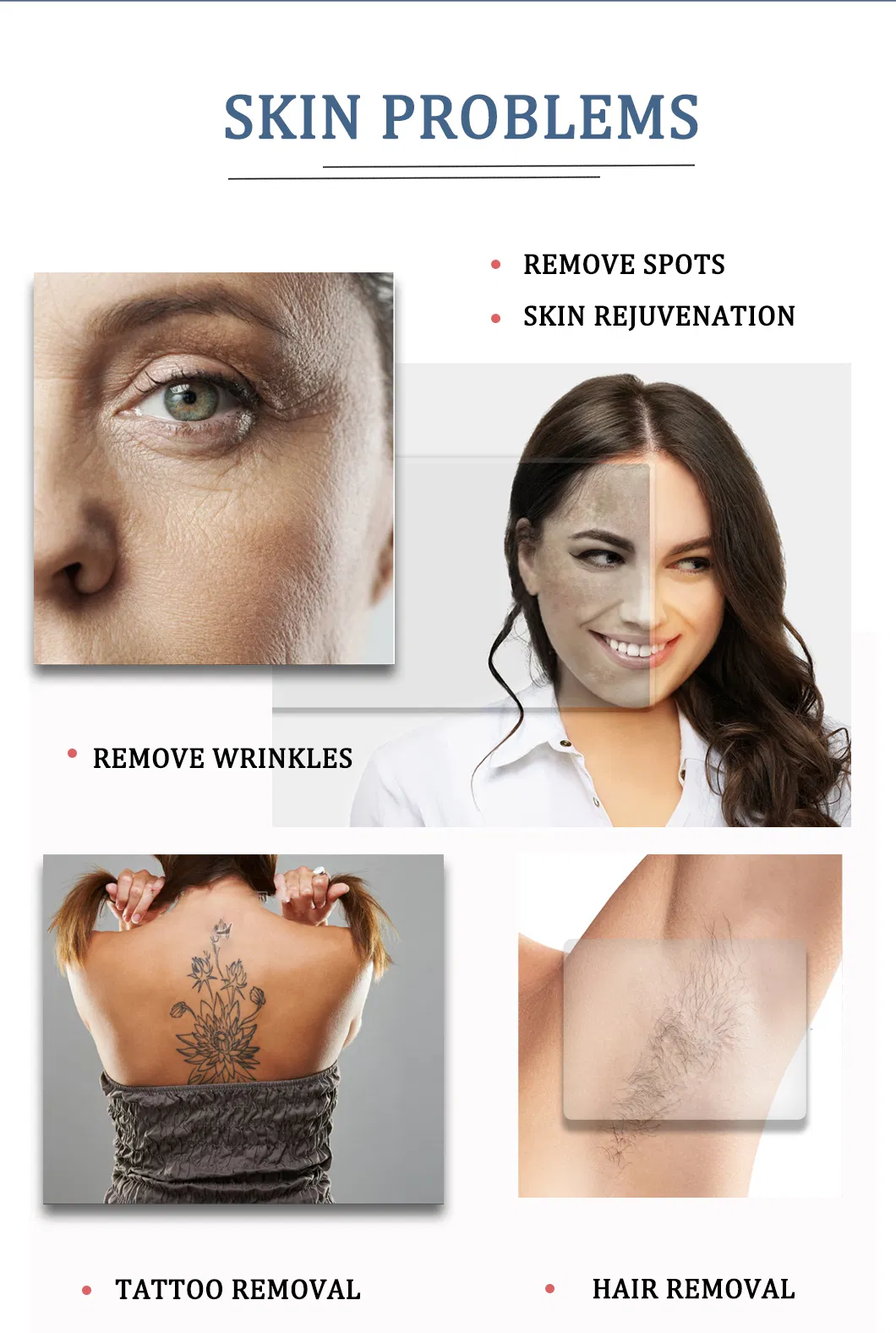 إزالة الشعر بشكل دائم بدون ألم باستخدام 5 في 1 تقنية IPL Opt Elight وتجديد البشرة