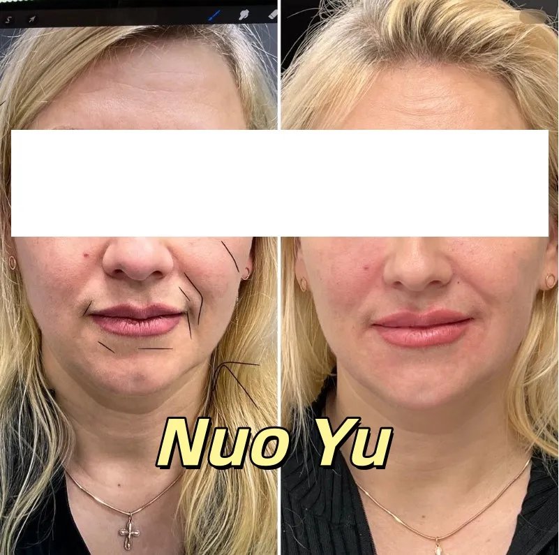 Hyaluronic Acid Filler Skin Treatment
