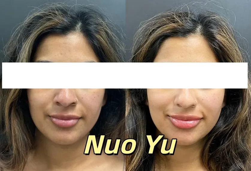 Hyaluronic Acid Lip Filler