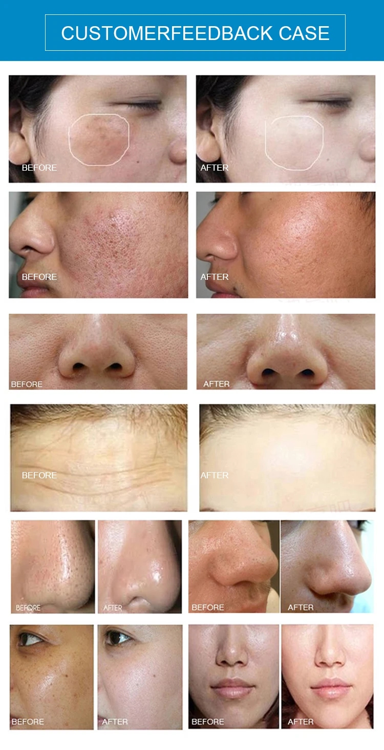 5 in 1 Desktop Hydro Bubble Water Dermabrasion Face Cleaning BIO Microcurrent Face Care Machine