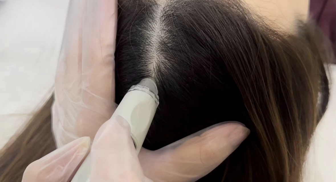 Deep scalp cleansing