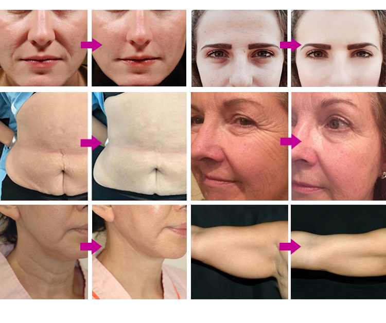 Before and After Results