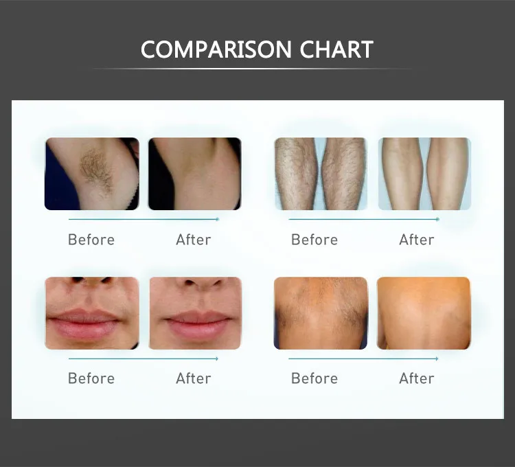 Laser Scar and Acne Removal Beauty IPL Beauty Machine Wrinkle Removal Facial Massage Machine