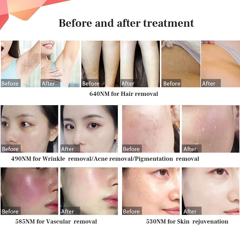 DPL Rejuvenation Detail 1
