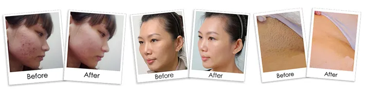 Before and After Treatment
