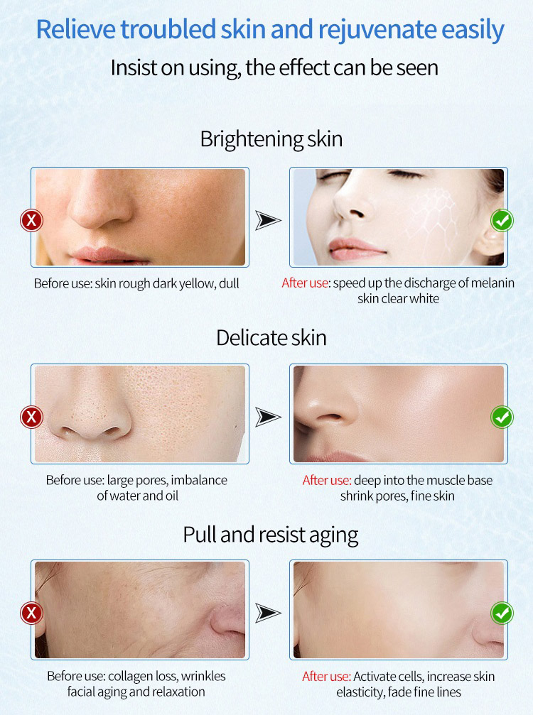 Cool Skin Tightening Machine Detail 10