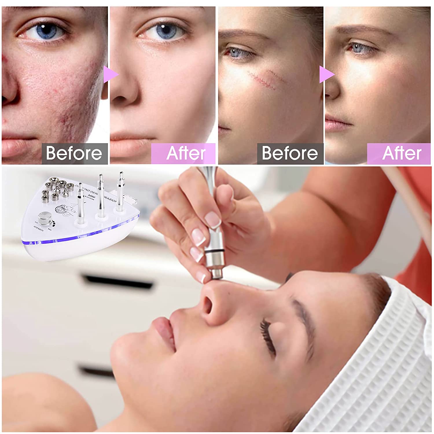 Diamond Dermabrasion System Technical Details