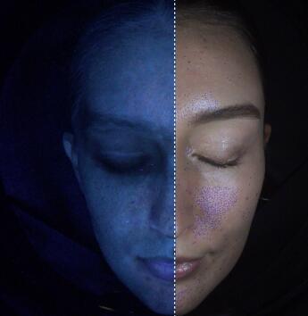 Acne / Pores