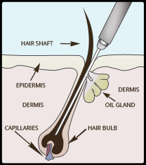 Permanent Hair Removal Technology