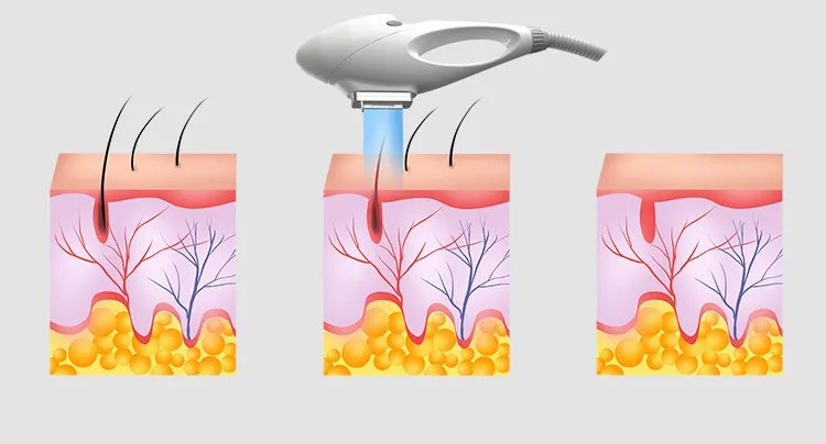 Multifunctional Dpl+Elight +IPL + RF Facial Anti-Aging Equipment IPL Dpl Skin Rejuvenation Hair Removal Machine