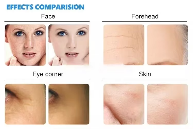 Microdermabrasion Diamond Dermabrasion Water Oxygen Jet Peeling Face Blackhead Removal Skin Rejuvenation Hydrating Machine Detail 2
