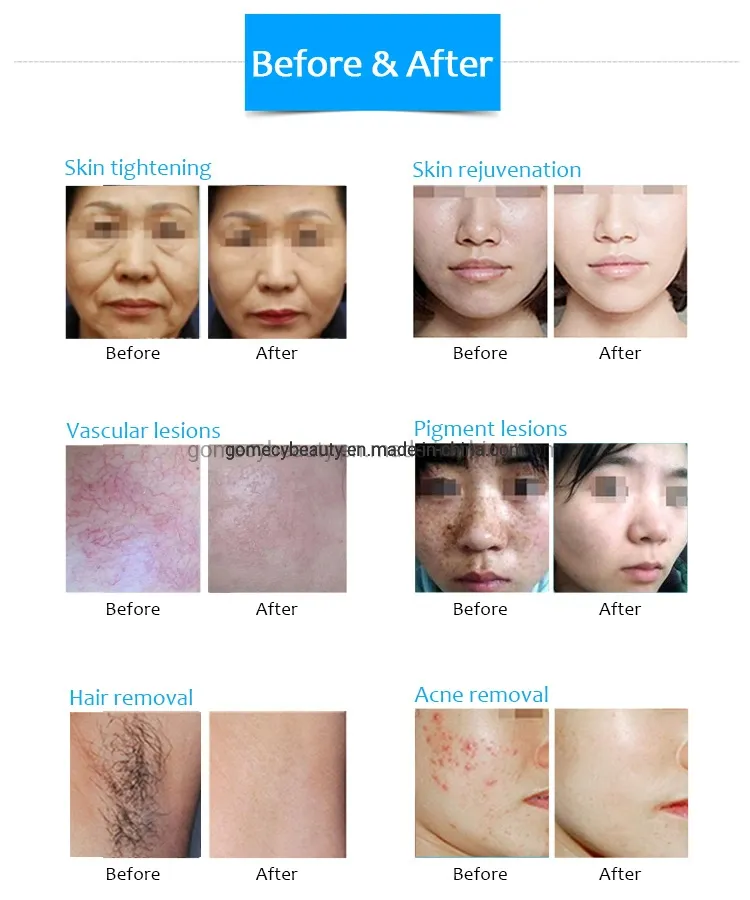 Opt IPL + Elight + RF + ND YAG Laser 4 in 1 Multifunction Facial Treatment