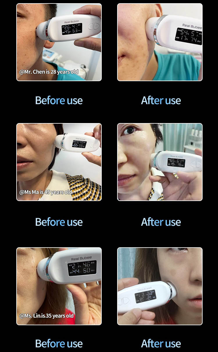 Cool Skin Tightening Machine Detail 6