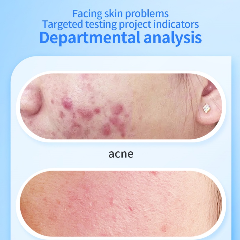 Best Skin Analyzer for Skin Analysis Face Skin Machine Facial Device
