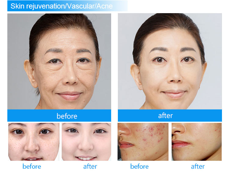 Before and After Results 1