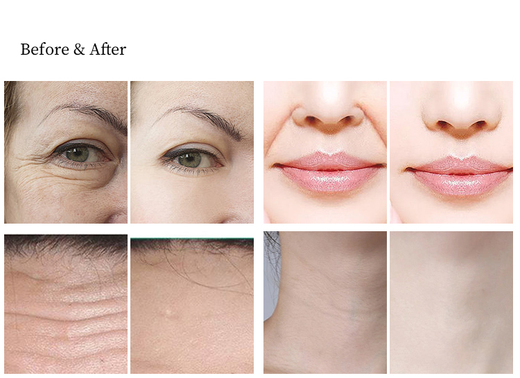 7D HIFU Machine ABS Face Lifting High Intensity Brush Skin Firming Anti-aging 7-Piece Cartridge