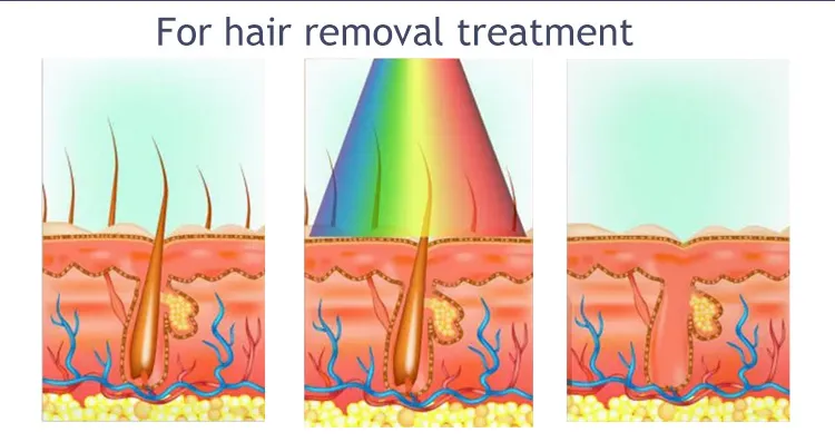 Hair Removal Home IPL Device Pulse Light Epilator Depilador Facial Laser Machine