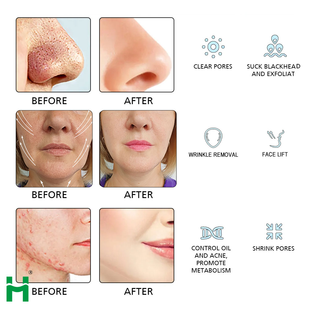 Professional Spa Ultrasonic Skin Rejuvenation Hydro Aqua Facial System with Dermabrasion Microdermabrasion and Jet Peel Therapy