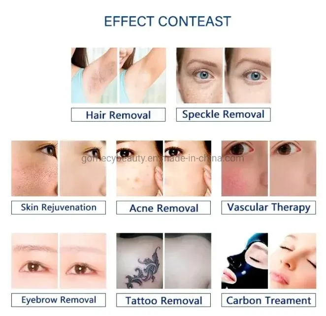 Opt IPL + Elight + RF + ND YAG Laser 4 in 1 Multifunction Facial Treatment
