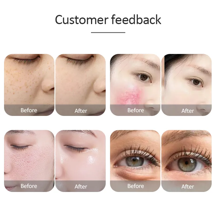 Medical CE Approved IPL Aesthetic Laser Hair Removal Elight Facial Permanent Hair Removal Machine