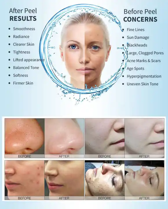 Dermabrasion Treatment View