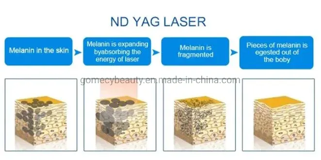 Opt IPL + Elight + RF + ND YAG Laser 4 in 1 Multifunction Facial Treatment