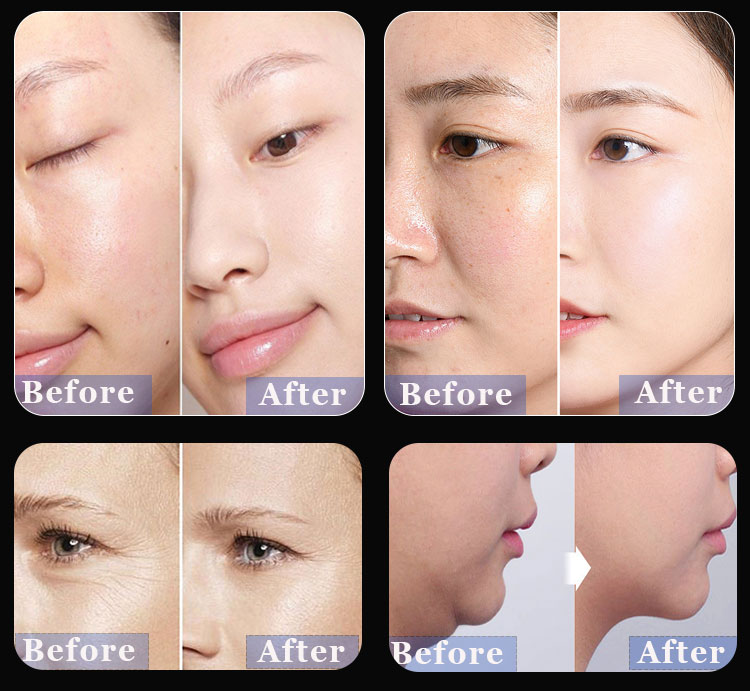 Microdermabrasion Machine Detail 7
