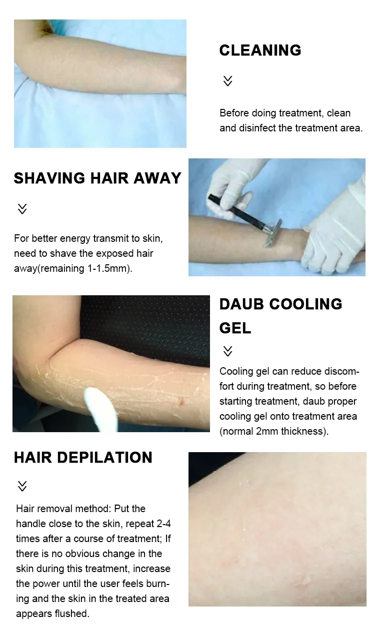 Medical CE Approved IPL Aesthetic Laser Hair Removal Elight Facial Permanent Hair Removal Machine