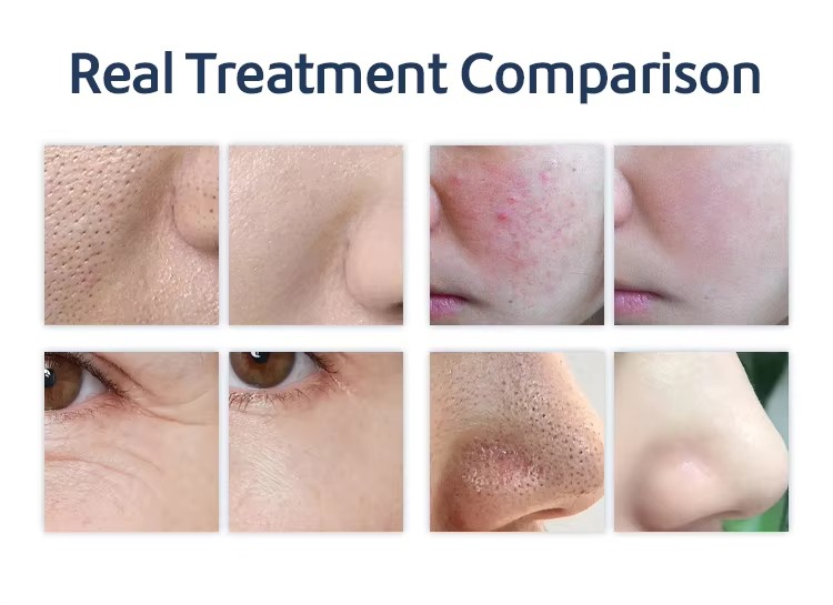 Advanced Skin Rejuvenation Machine Professional Aqua Peel Hydro Dermabrasion Device Portable Hydra Beauty Facial System