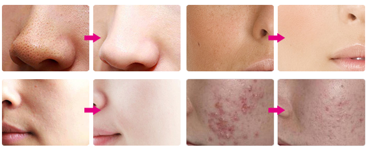Before & After Skincare Treatment