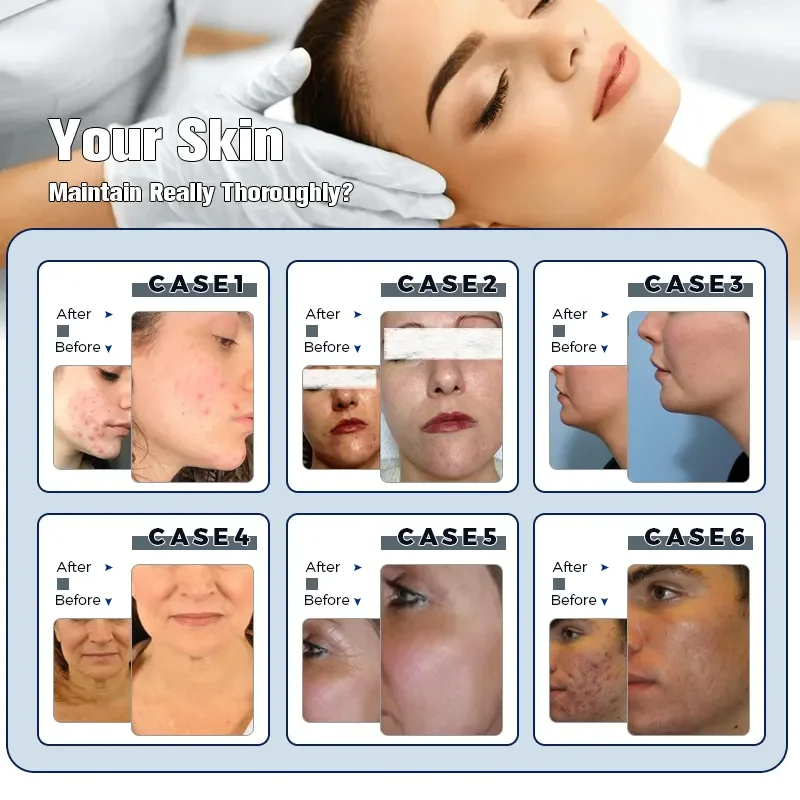 Latest Model 14-in-1 Diamond Hydro Dermabrasion Machine with Skin Analysis US &amp; IT Plugs