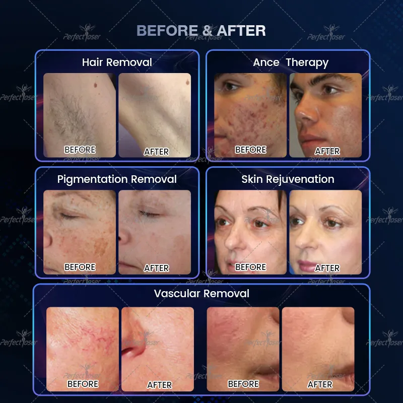 Laser IPL Machine for Facial Hair Removal Photofacial Beauty