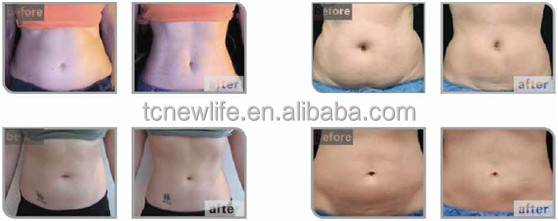 Clinical Cryo Treatment