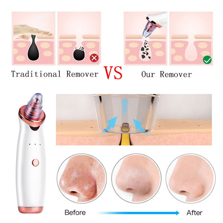 How to Use Blackhead Remover
