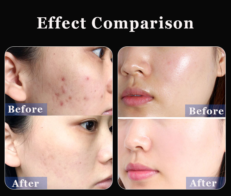 Microdermabrasion Machine Detail 6