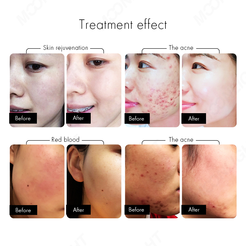 OEM Permanent IPL Diode Laser Facial Skin Rejuvenation Hair Freckle Removal