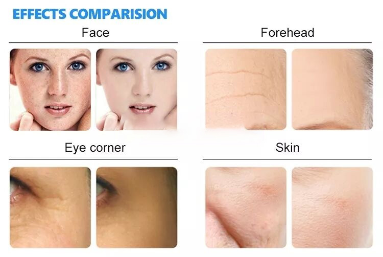 Household Hydra Microdermabrasion Peel Facial Oxygen Jet Machine Microdermabrasion Machine Black Head Removal