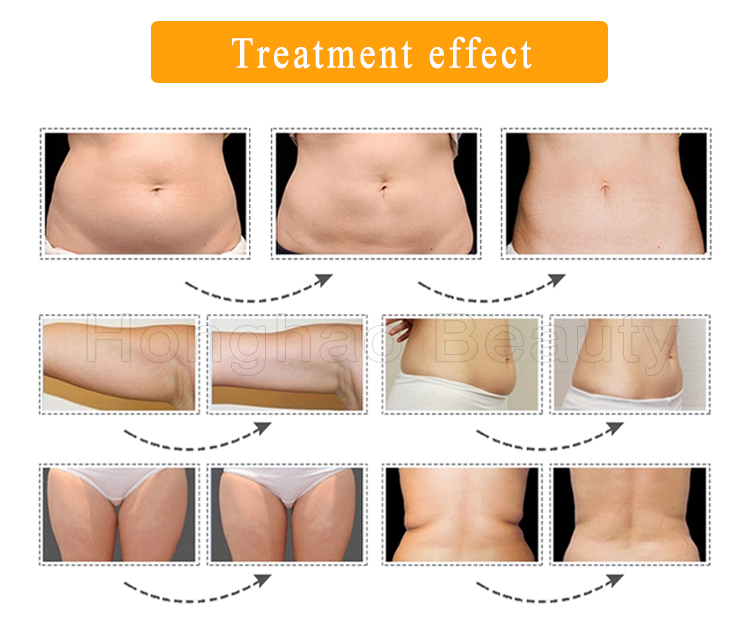Fat Reduction Results T Shock
