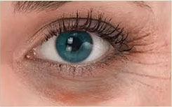Eye fine lines concern