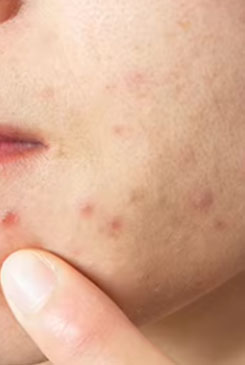 Oily Acne